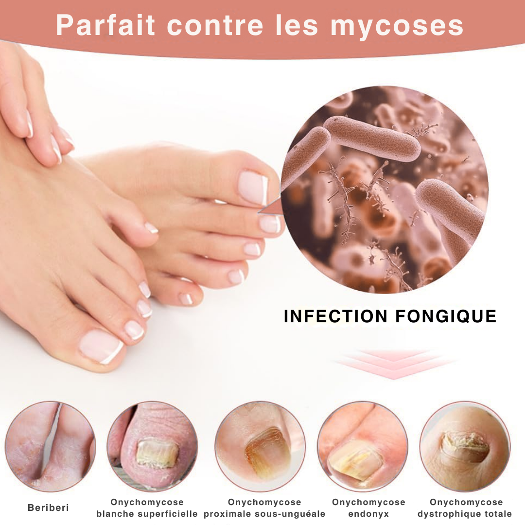 LumiPure™ - Photothérapie douce anti-mycose