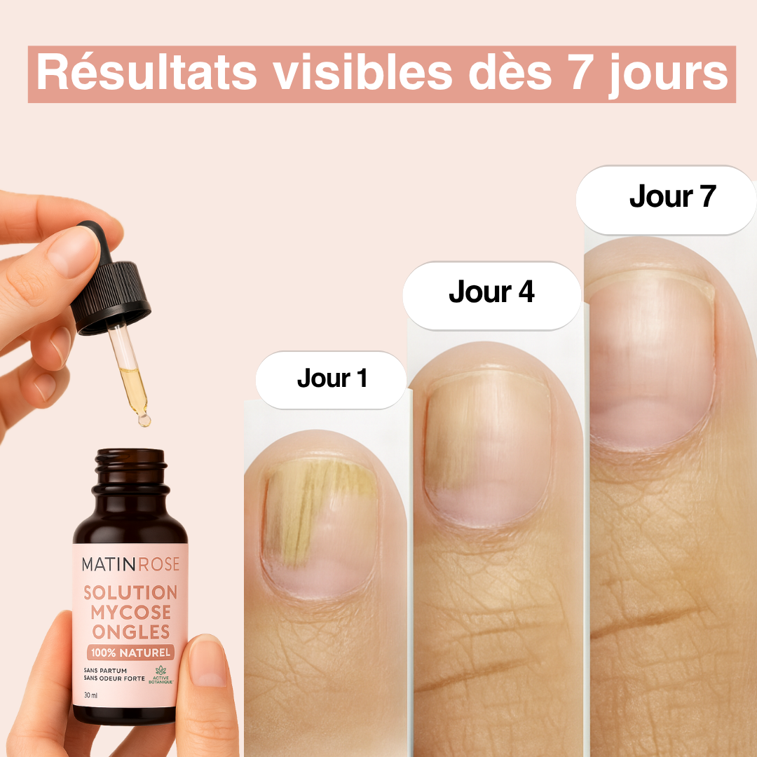 Solution anti-mycose - Formule 100% naturelle