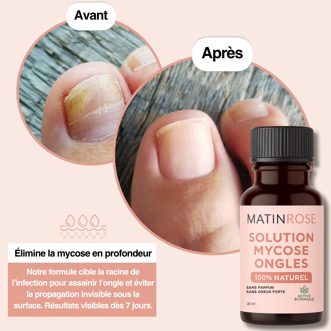 Solution anti-mycose - Formule 100% naturelle