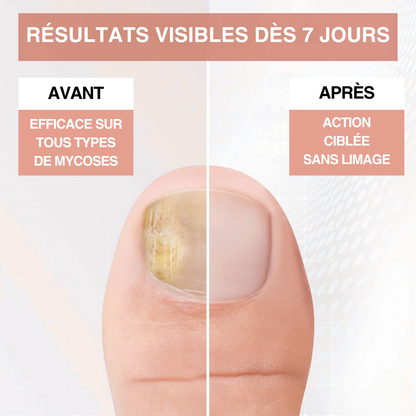 Solution anti-mycose - Formule 100% naturelle